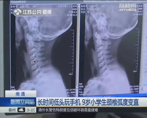 打游戏对颈椎,揭秘打游戏对颈椎的潜在伤害